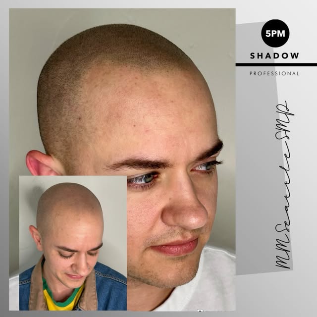 The only hair loss solution that’s  100% effective!

Scalp Micropigmentation Seattle 

Schedule your