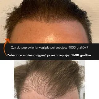 Czy do poprawienia wyglądu potrzebujesz aż 4000 graftów? 🤔
Zobacz co można osiągnąć przeszczepiając