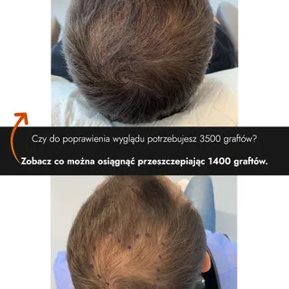 Czy do poprawienia wyglądu potrzebujesz aż 3500 graftów? 🤔
Zobacz co można osiągnąć przeszczepiając