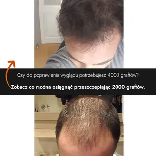 Czy do poprawienia wyglądu potrzebujesz aż 4000 graftów? 🤔
Zobacz co można osiągnąć przeszczepiając