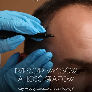 Czy w przeszczepie włosów więcej graftów zawsze oznacza lepszy efekt? 🤔

Wiele klinik podkreśla w s