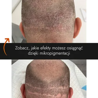 Zobacz, jakie efekty można osiągnąć dzięki mikropigmentacji skóry głowy 🧑‍🦲👉🧑‍🦰

Problem dotycz