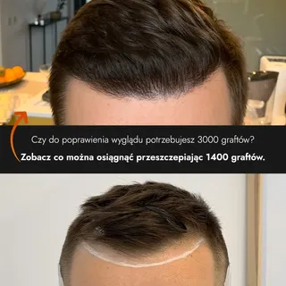 Czy do poprawienia wyglądu potrzebujesz aż 3500 graftów? 🤔
Zobacz co można osiągnąć przeszczepiając