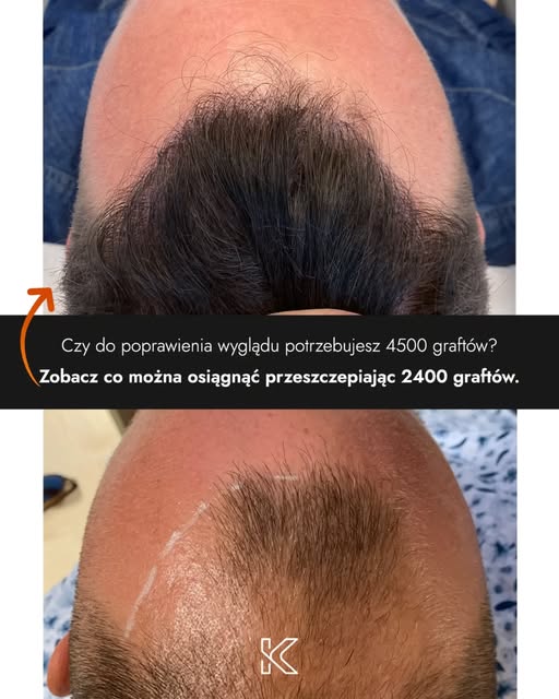 Czy do poprawienia wyglądu potrzebujesz aż 4500 graftów? 🤔
Zobacz co można osiągnąć przeszczepiając