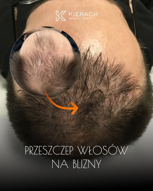 🔬 Przeszczep włosów na blizny - czy to możliwe?

Blizny na skórze głowy mogą powstać w wyniku urazó