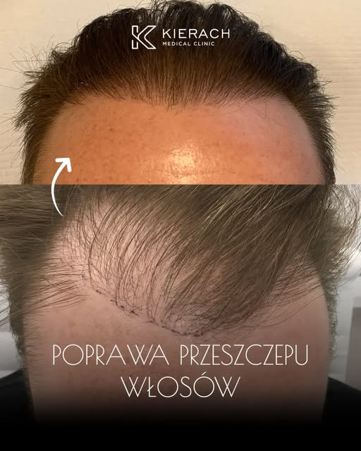 🔬 Nieudany przeszczep włosów nie musi oznaczać końca drogi.

Zdarza się, że efekt wcześniejszego za