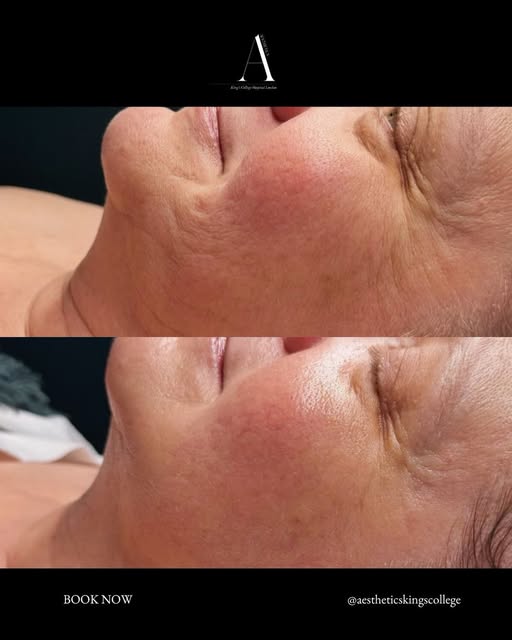 The before and after says enough. 🤍

After just one Morpheus8 session, we’re seeing visible improve