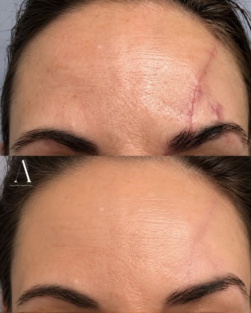 Here’s a before and after result following scar removal by Dr Dragana Spica. The difference shows ho