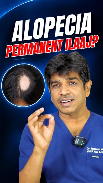 **“Kaash Main Pehle Aa Gaya Hota…” — Alopecia Areata Patient**

Alopecia Areata mein hair loss aksar
