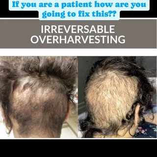 “Irreversible over-harvesting during hair transplants can lead to significant damage and long-term i