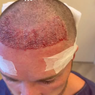 Reconstruction of a hairline #fuehairtransplant #londonhairtransplant #turkeyfuehairtransplant #hair