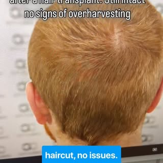 @city.clinics This what your back of the head should look like after a hair transplant. No signs of 