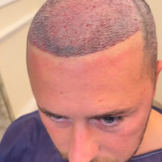 “A new hairline isn’t just about hair — it’s about confidence, identity, and feeling like yourself a