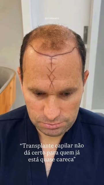 A viabilidade de um transplante capilar depende da densidade que sobrou na área doadora, muito mais 