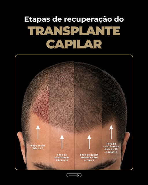 Um dos maiores medos de quem faz transplante é olhar no espelho nas primeiras semanas e achar que de