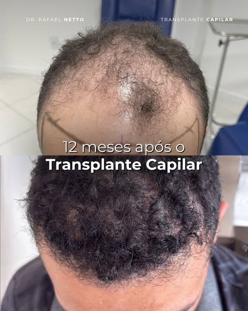 Um ano de acompanhamento com esse paciente e eu preciso agradecer publicamente pela confiança 🙌

Po