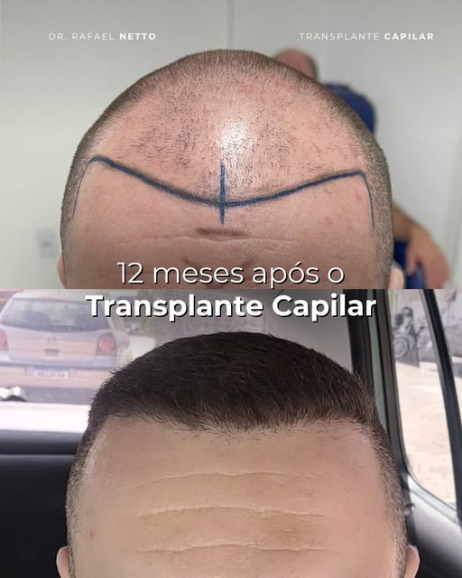Um ano de acompanhamento de Transplante Capilar resumido em dez fotos.

O que sempre chama a atenção