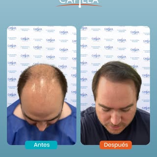 Un buen injerto capilar transforma tu imagen…
y redefine tu antes y después.

No se trata de ocultar