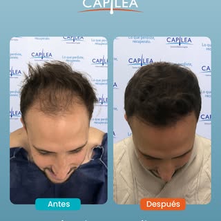 De un antes con dudas…
a un después con resultados gracias al injerto capilar.

Tu cambio también es