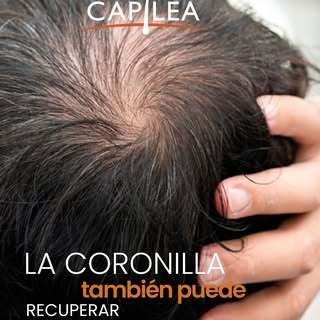 La coronilla es una de las zonas donde más cuesta disimular la pérdida de cabello 👀

Y muchas veces