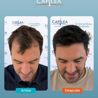 9 meses. Un implante capilar. Un cambio que va mucho más allá del cabello.

Este paciente llegó a Ca