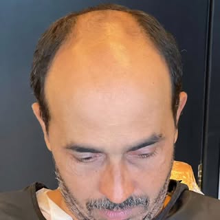 8 meses de pós operatório, cerca de 70% do resultado final e já temos uma transformação no visual do