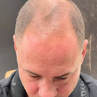 Calvície extensa, grau de dificuldade alto pelo calibre do fio mas conseguimos entregar essa bela tr
