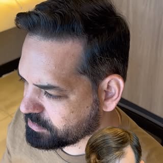 Mais um resultado de altíssimo nível com assinatura do Núcleo Capilar, retorno com 1 ano de pós oper