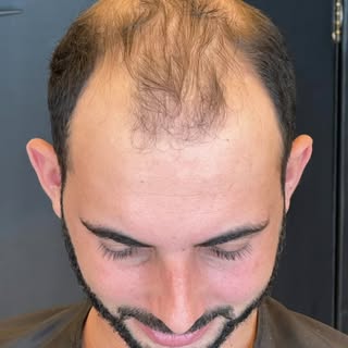 Isso é Núcleo Capilar, meus amigos! 🔥🚀

Restauração de calvície extensa em paciente jovem, caso mu