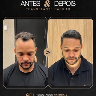 Restauração extremamente natural!! ✅🚀

Em calvícies menores nosso principal objetivo é não perder a