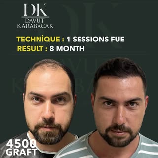 Davut Karabacak Hair Clinic
Exclusive Hair Restoration Experience
• Complimentary Hair Analysis
• Be