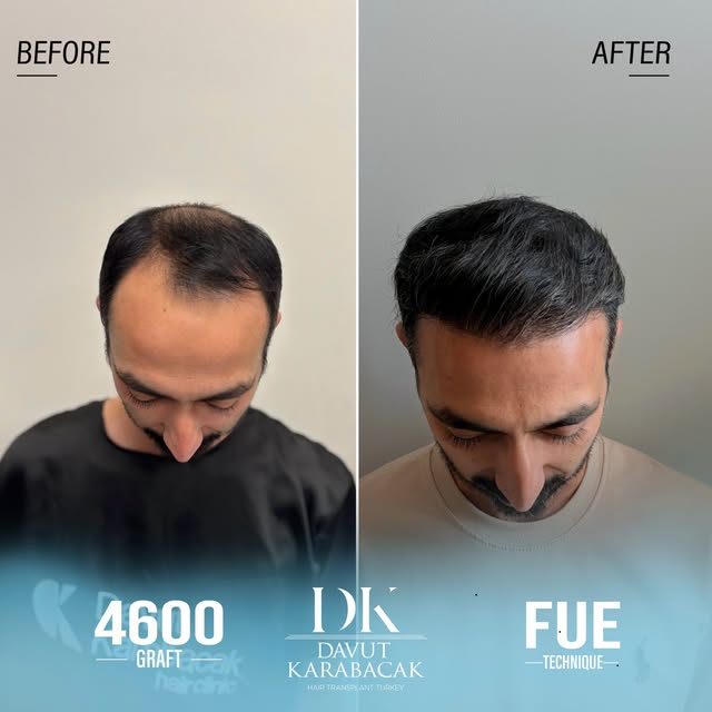 Davut Karabacak Hair Clinic
Exclusive Hair Restoration Experience
• Complimentary Hair Analysis
• Be