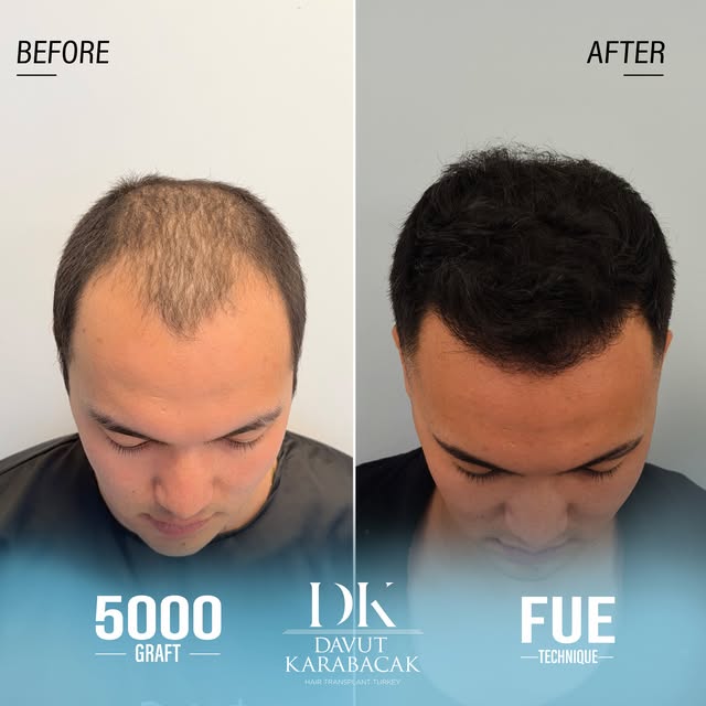Davut Karabacak Hair Clinic
Exclusive Hair Restoration Experience
• Complimentary Hair Analysis
• Be