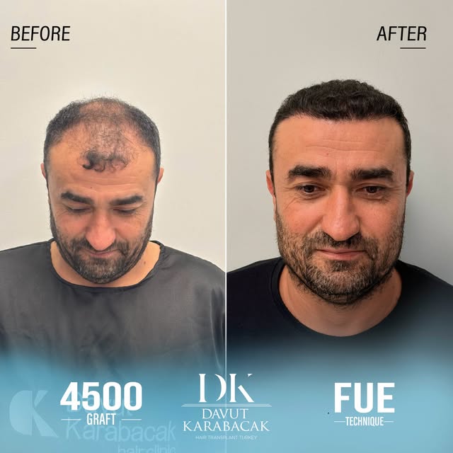 Davut Karabacak Hair Clinic
Exclusive Hair Restoration Experience
• Complimentary Hair Analysis
• Be