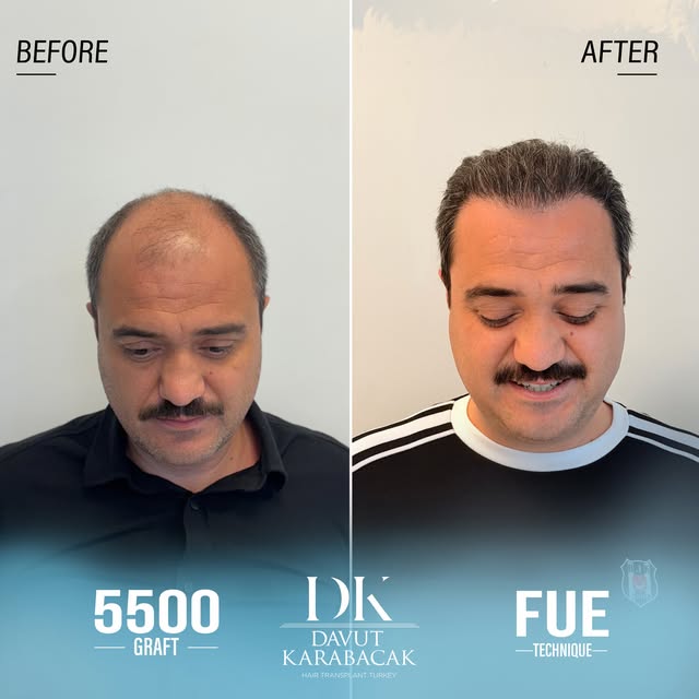 Davut Karabacak Hair Clinic
Exclusive Hair Restoration Experience
• Complimentary Hair Analysis
• Be