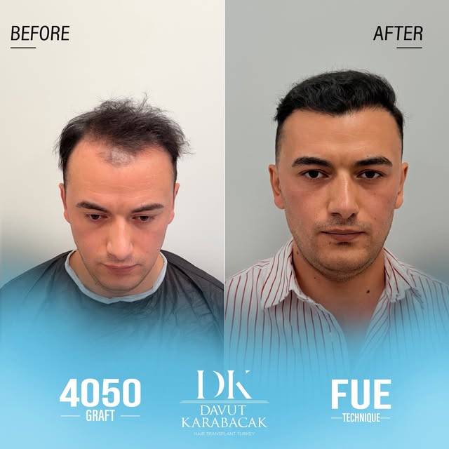 Davut Karabacak Hair Clinic
Exclusive Hair Restoration Experience
• Complimentary Hair Analysis
• Be