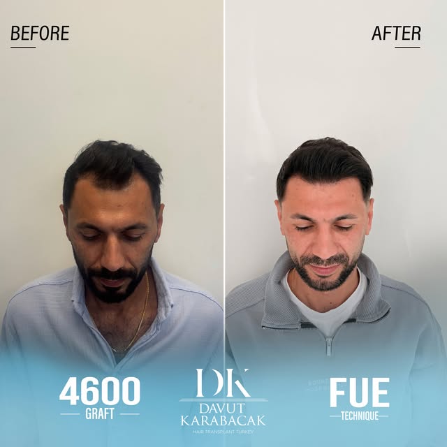 Davut Karabacak Hair Clinic
Exclusive Hair Restoration Experience
• Complimentary Hair Analysis
• Be