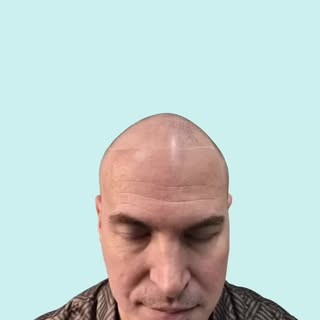 Say goodbye to thinning hair and hello to confidence with Scalp Micropigmentation (SMP)! Whether you