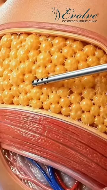 Targeted Fat. More Defined Contours.

Struggling with stubborn fat in specific areas despite a healt