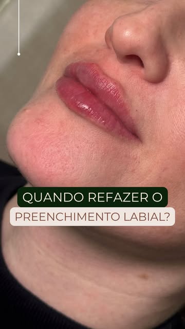 Com que frequência você deve refazer o seu preenchimento labial? 🤔 👄 

#preenchimentolabial #derma