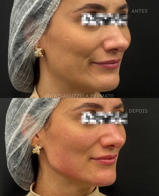 Contorno facial com preenchimento de ácido hialurônico, nesse caso foram usados 3ml ✨
(Já tínhamos f