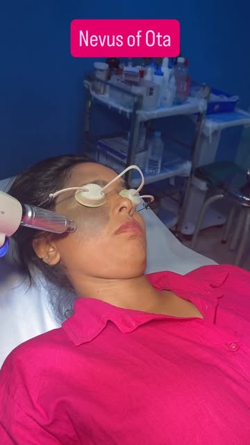Nevus of Ota is a type of dermal pigmentation that can be treated with specific Laser therapy. Treat