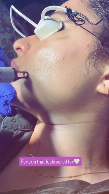 Every skin concern deserves the right treatment and gentle care.✨🌼✨#lasertreatment#mole #scar #skin