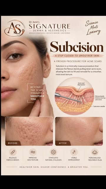 ✨ Acne scars don’t have to be permanent.

Subcision works beneath the skin to release the fibrous ba
