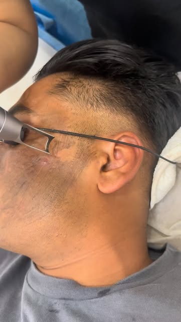 Dull Skin? Open Pores? Excess Oil?

Try Carbon Laser Treatment in Mira Road at Newderma Aesthetic Cl