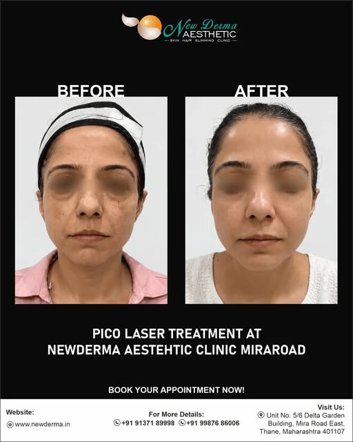 Reduce the appearance of pigmentation with Pico Laser ✨

Pico Laser treatment at New Derma Aesthetic