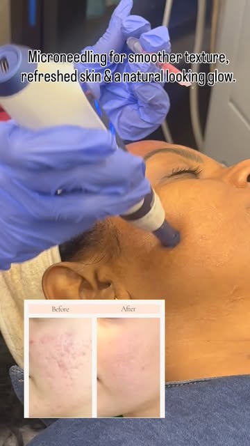 Refresh your skin with Microneedling at NewDerma Aesthetic Clinic, Mira Road ✨

A targeted skin reju