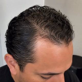 Hair loss doesn’t look the same for everyone.

Some men experience a receding hairline. Others notic