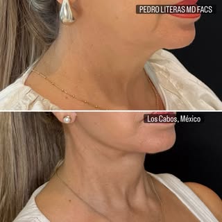 Refinement is not about looking different.
It’s about looking elevated.

A sculpted jawline, a clean