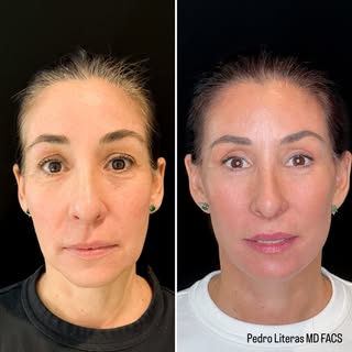 5 months after comprehensive facial rejuvenation.
The goal was never to make her look like someone e